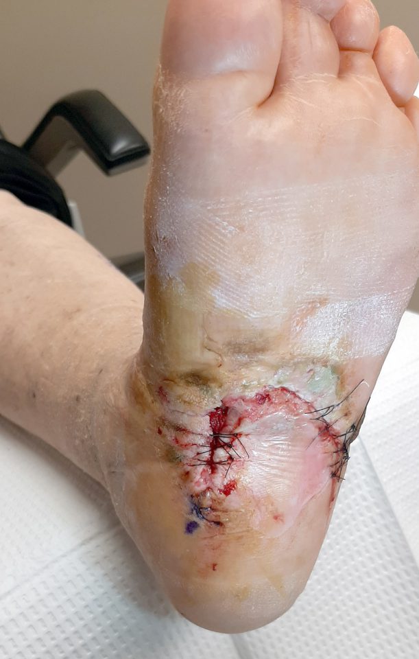 after-stitches