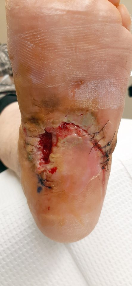 before stitches