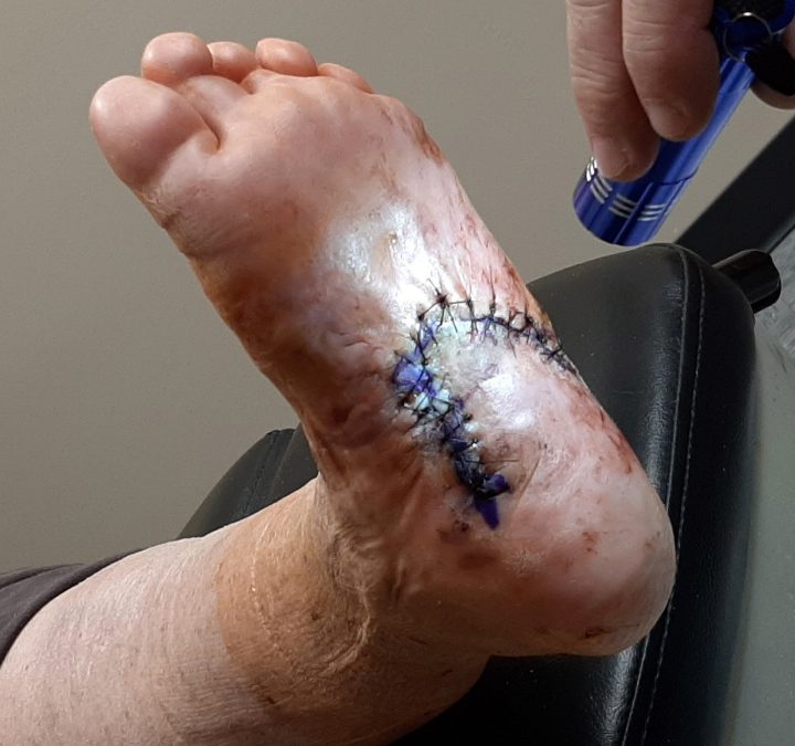 foot-1